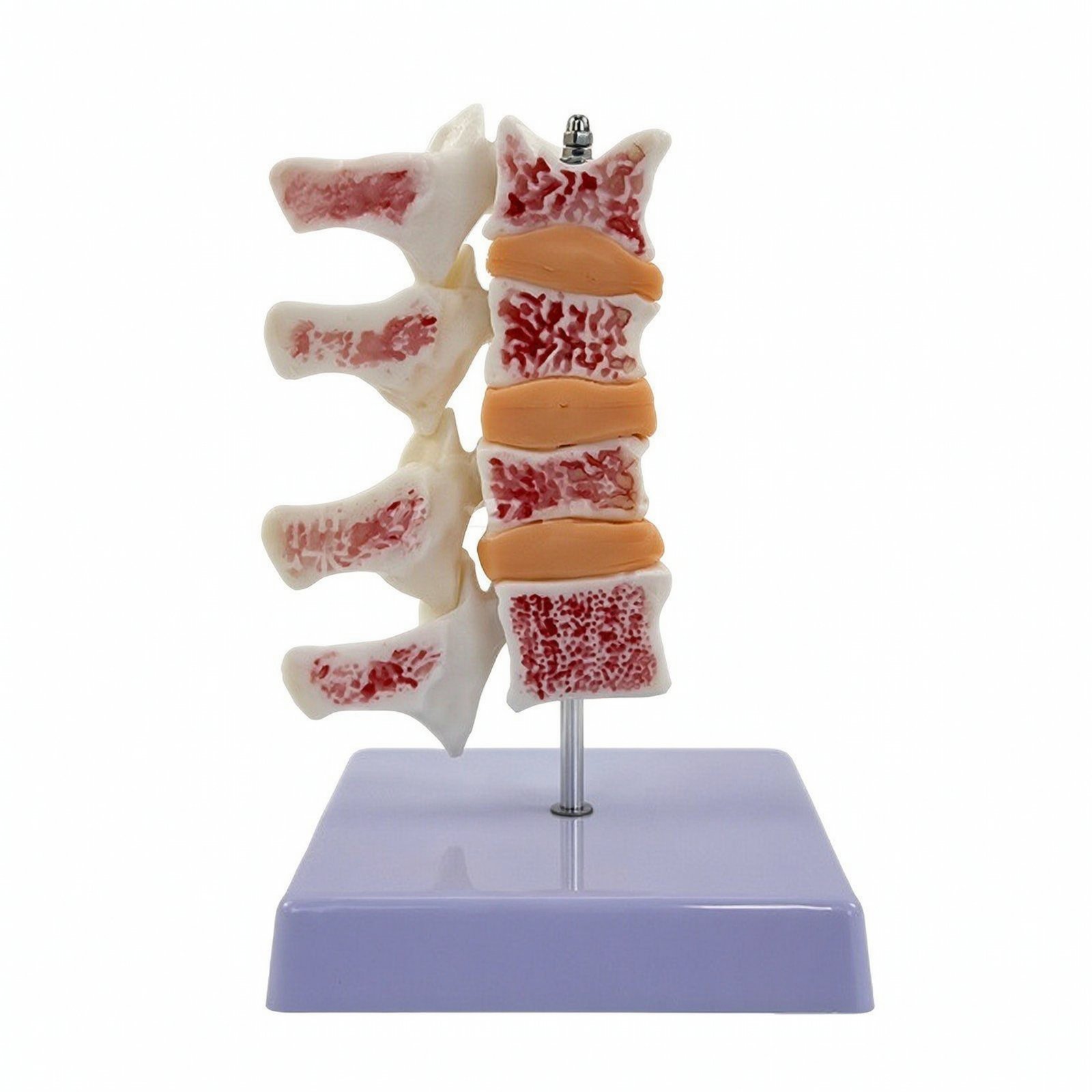 Osteoporosis Spine Model